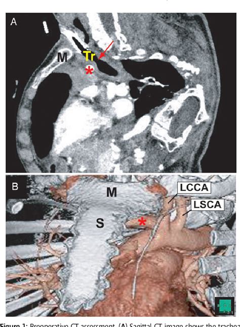 Figure 1 From The Left Anterior Extrapleural Approach For Innominate
