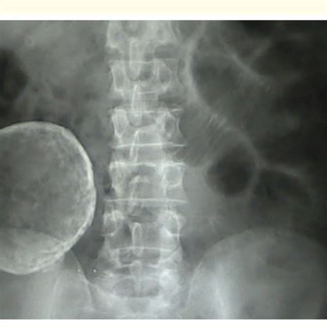 X Rays Calcified Abdominal Mass Download Scientific Diagram