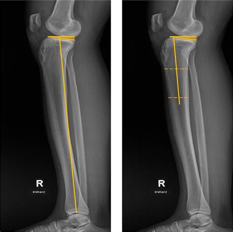 Lateral Radiographs Of The Lower Limb Showing The Measurement Of The