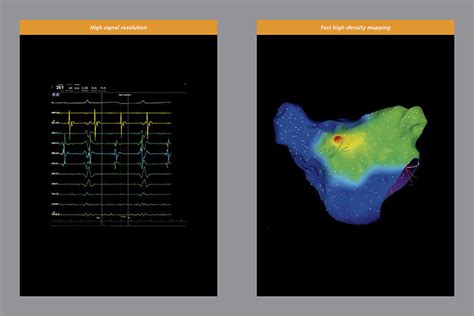 Mapping Catheter Carto Pentaray Biosense Webster