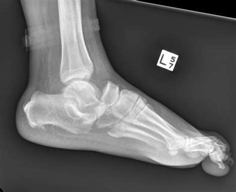 Chopart Fracture Dislocation Radiology Case