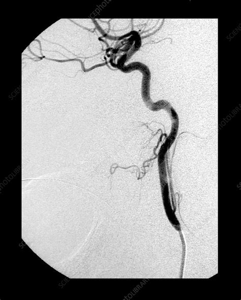 Internal Carotid Artery Angiogram Stock Image C0075814 Science