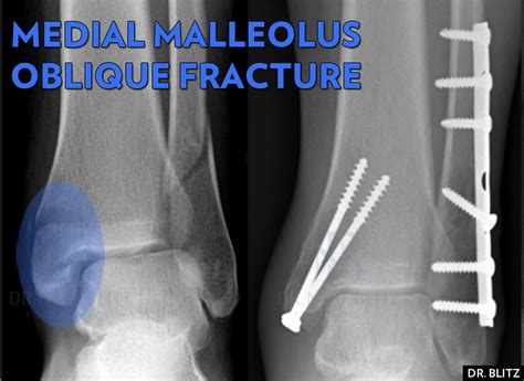 Lateral Malleolus Avulsion Fracture