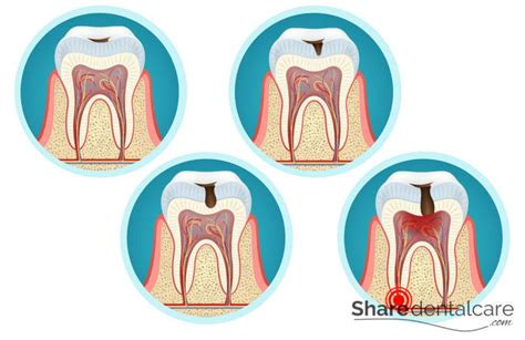 Dental Caries Stages And Causes Share Dental Care