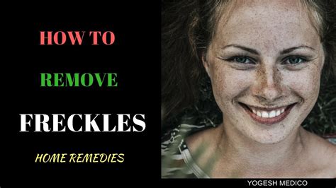 How can freckles be removed? HOW TO REMOVE FRECKLES - HOME REMEDIES - YouTube