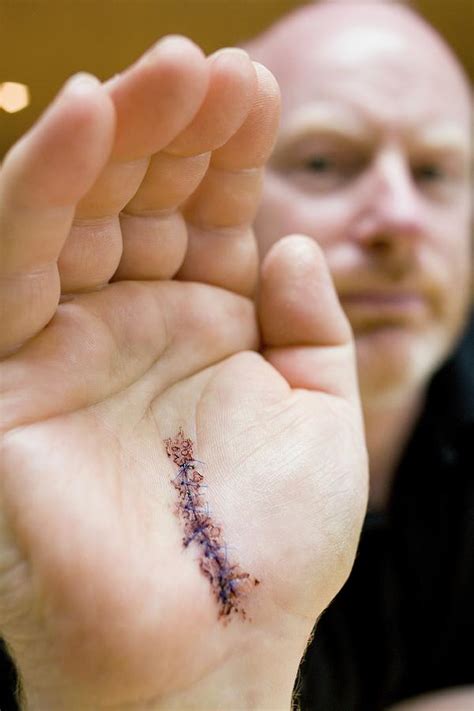 Surgical Wound Photograph By Samuel Ashfieldscience Photo Library