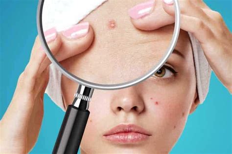 Does Acne Go Away Naturally Plus 5 Tips Skin Care Geeks