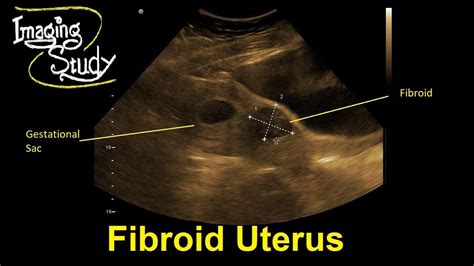 Early Pregnancy With Uterine Fibroid Ultrasound Case 31 Youtube
