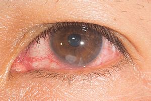 Corneal Scar Treatment