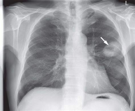 Tumors Of The Lung Radiology Key