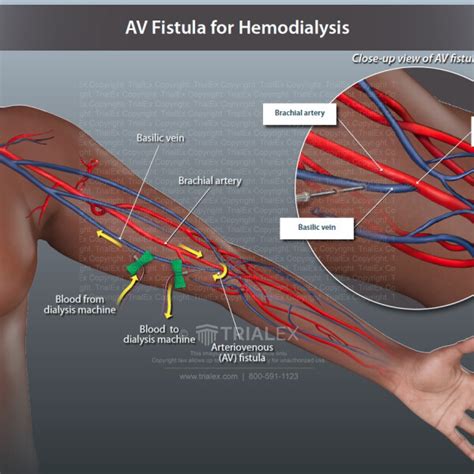 Resultado De Imagen De Arteriovenous Fistula Hemodialysis Dialysis My