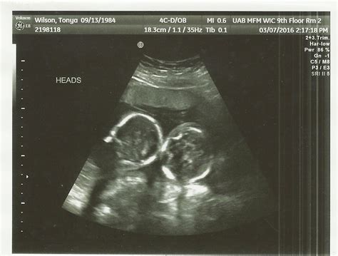 20 Week Ultrasound With Twins