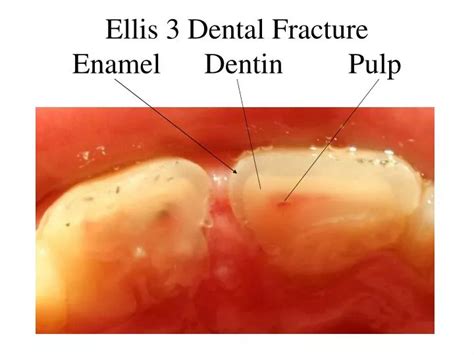 Ppt Ellis 3 Dental Fracture Enamel Dentin Pulp Powerpoint