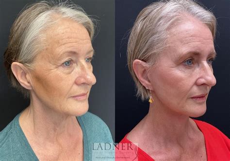 eyelid surgery blepharoplasty before and after pictures case 189 denver co ladner facial