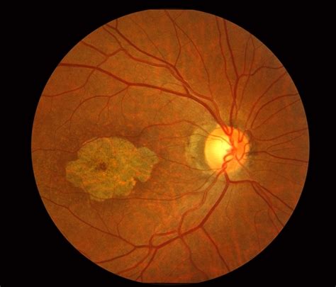 Stargardt Macular Dystrophy Slide 1 Retina Image Bank
