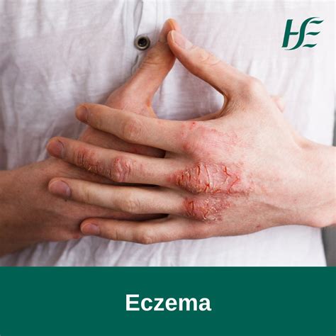 Hse Ireland On Twitter Eczema Is A Skin Condition That Causes Areas