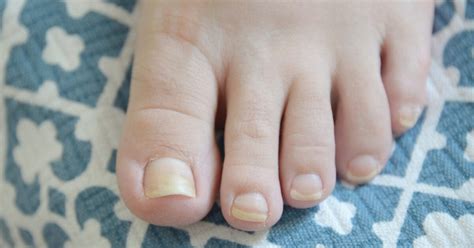 Yellow Toenails Causes Prevention And Treatments