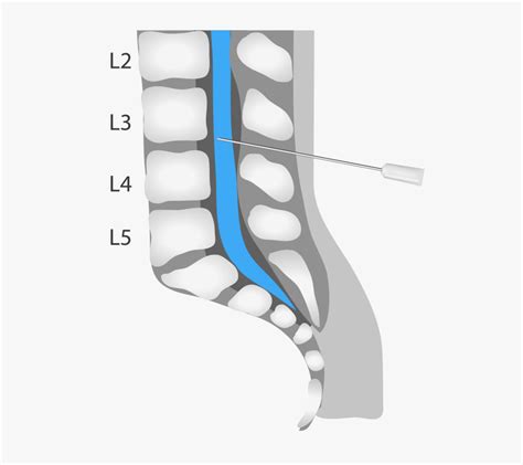 Lumbar Puncture Bristol Spine Intervention