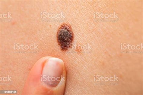Dangerous Nevus On Skin Melanoma Stock Photo Download Image Now