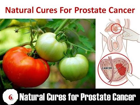 Prostate Cancer And Prostatitis Treatment With Natural Home Remedies