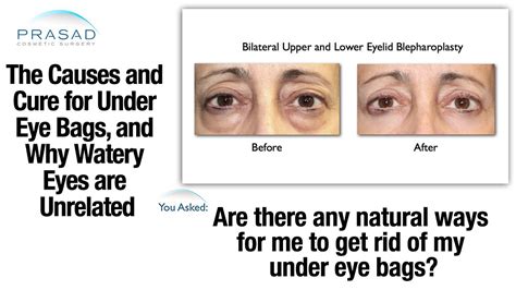 How Under Eye Bags Surgery Is Performed And The Causes Of Watery Eyes