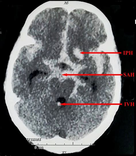 Axial Non Contrast Ct Image Showing Diffuse Subarachnoid Hemorrhage