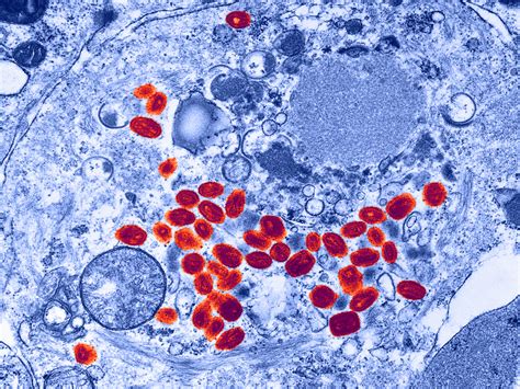 Smallpox Virus Found In Unsecured Nih Lab Shots Health News Npr
