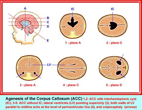 Agenesis Of The Corpus Callosum Department Of Obstetrics And