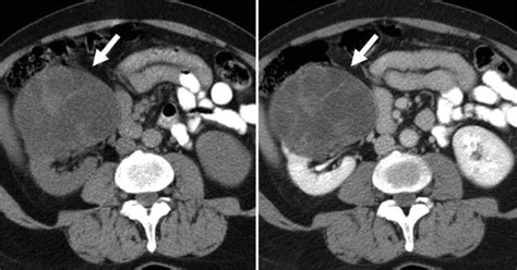 Venous thrombus in the renal vein or ivc can usually be identified on the venous phase or delayed phase of the initial diagnostic ct. Unenhanced (left) and portal venous phase (right) CT shows ...