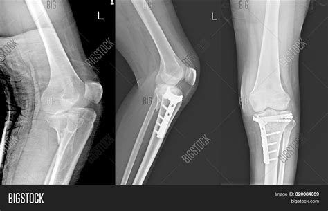 X Ray Knee Joint Image And Photo Free Trial Bigstock