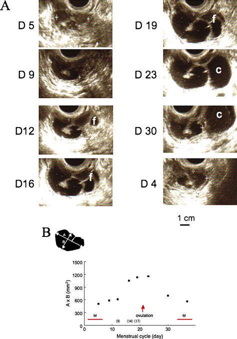 A Case Of Hydrosalpinx Associated With The Menstrual Cycle Fertility