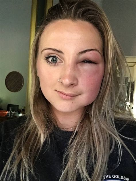 Psbattle Girl With Half Her Face Swollen From A Bee Sting R