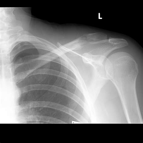Breast Cancer Metastasis To Distal Clavicle Pathological Fracture