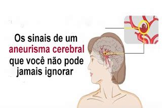An intracranial aneurysm, also known as a brain aneurysm, is a cerebrovascular disorder in which weakness in the wall of a cerebral artery or vein causes a localized dilation or ballooning of the blood vessel. Os sinais de um aneurisma cerebral que você não pode ...