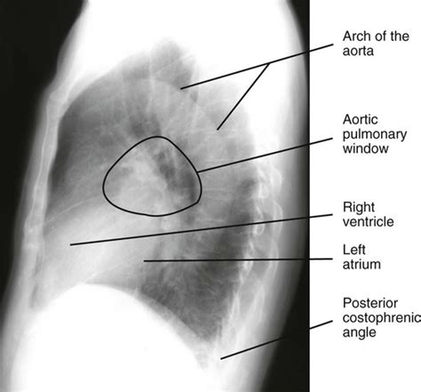 Introduction To Chest Radiography Radiology Key