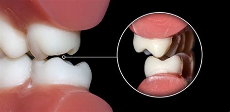Teeth Grinding Dentist Neutral Bay Shore Dental