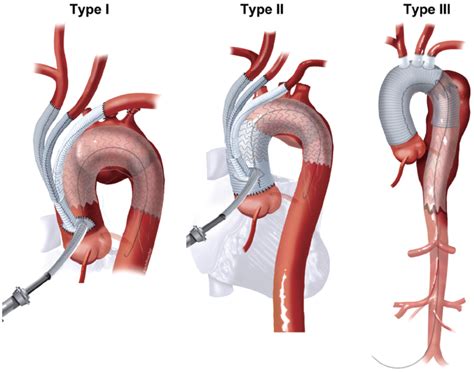 Type I And Type Ii Hybrid Aortic Arch Replacement Postoperative And