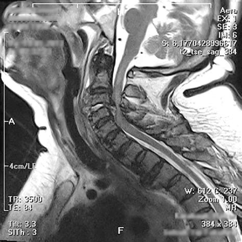 Severe Spinal Cord Compression Widespread Spinal Cord Edema