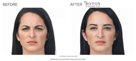 Botox Before And After Real Results From Real Patients