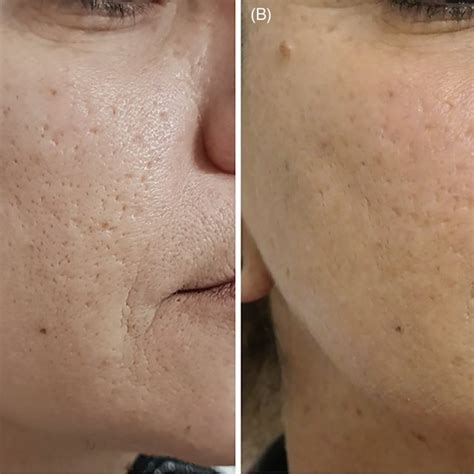 Treatment Of Acne Scars With Fractional Laser Two Sessions A