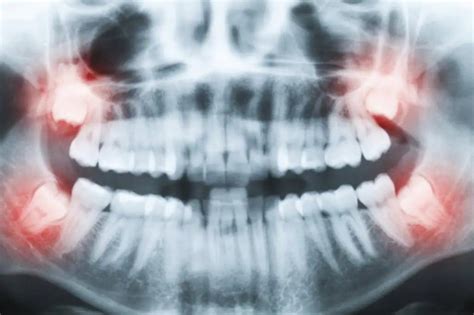 Floor Of Mouth Swollen After Tooth Extraction Review Home Co