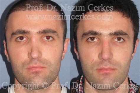 Perma yapıldıktan sonra, saça şekil vermeden önce yapılır. Revizyon Burun Estetiği Öncesi Sonrası Erkek Hastalar
