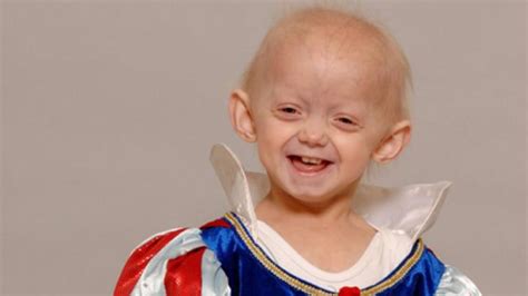 Progeria Descripción De La Enfermedad 2023