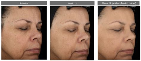 Figure 6 Photographs Of A 62 Year Old Subject With Fitzpatrick Skin