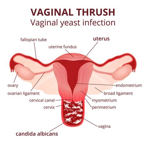 Yeast Infections Everything You Need To Know South Avenue Women S