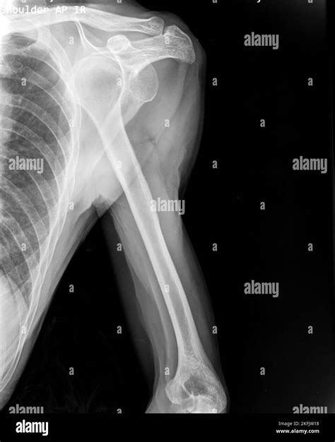 Dislocated Shoulder X Ray Stock Photo Alamy