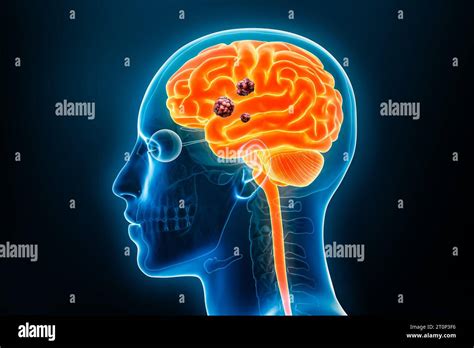 Human Brain Cancer With Cancerous Cells Or Tumors X Ray 3d Rendering