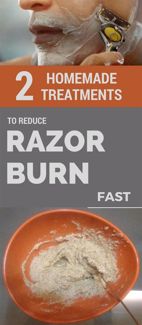 2 Homemade Treatments To Reduce Razor Burn Fast Razor Burns Home Remedies For Burns Razor