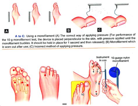 Assessment Of Sensation Using A Nylon Semmes Weinstein Monofilament 11