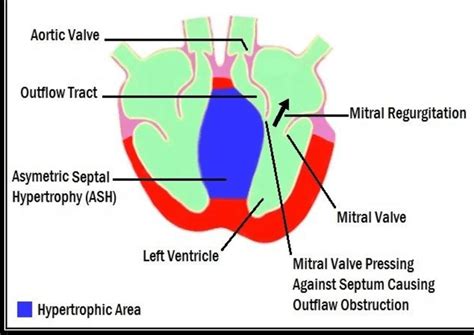 Asymmetrical Septal Hypertrophy With Obstruction 3 Concentric